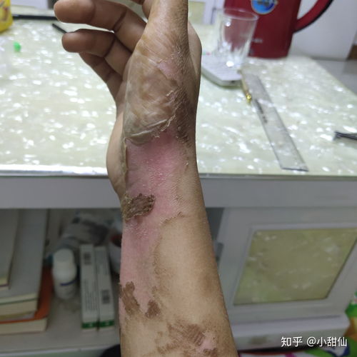 被油烫伤，被油烫伤后红色疤痕怎么去除