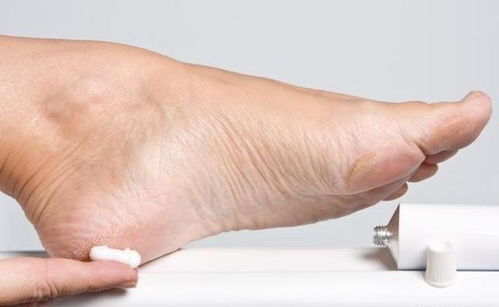 治脚臭的小妙招