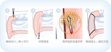 副乳吸脂效果好不好?