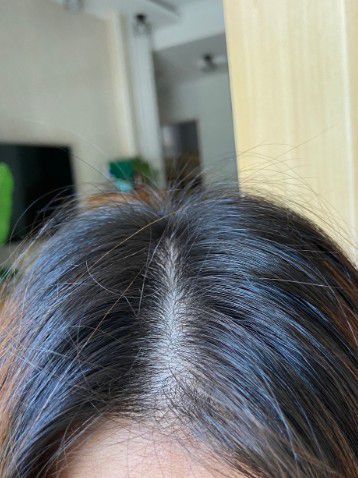 头屑多怎么办