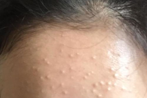闭口痘痘如何快速消掉?