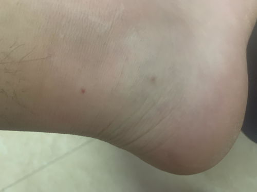 身上小红点是怎么回事