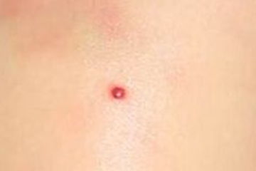 朱砂痣是什么意思