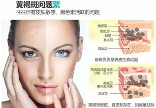 怎样消除黄褐斑，怎样消除黄褐斑老年斑