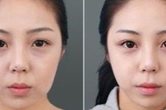 做双眼皮埋线好还是割的好呀，做双眼皮是埋线好还是割好