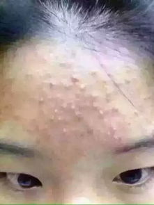 闭口痘痘，闭口痘痘怎么可以有效的去除
