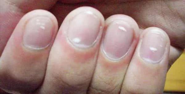 这是灰指甲吗?他说不疼不痒没感觉,大概得有最低六七年了,好像没啥变化
