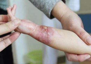 孩子烫伤后怎么急救