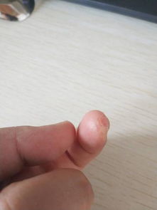 指尖脱皮，指尖脱皮是什么原因