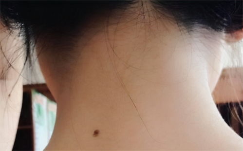 脖子有痣，脖子有痣的男人