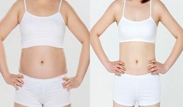 吸脂减肥的常用方法