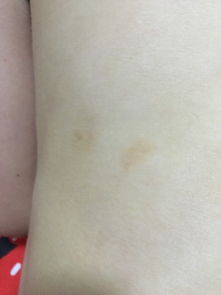 怎样冶皮肤痒，怎样治疗皮肤瘙痒
