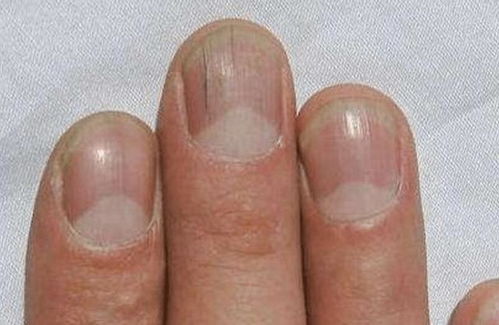 指甲上有竖纹怎么回事