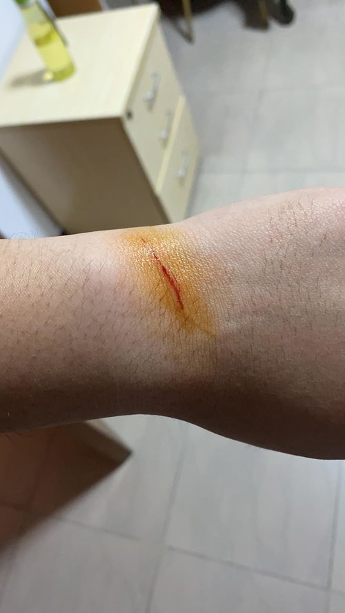 被猫咪抓伤怎么处理?