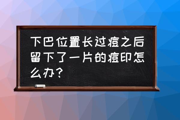 雀斑痘印怎么去除9个小妙招 下巴位置长过痘之后留下了一片的痘印怎么办? 雀斑痘印怎么去除9个小妙招 下巴位置长过痘之后留下了一片的痘印怎么办?
