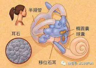 耳石症是什么病,怎么回事,严重吗,需要怎么治疗?