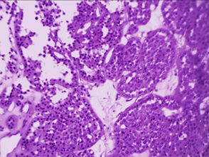 嗜酸细胞，嗜酸细胞绝对值0