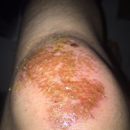 伤口流清水是好还是坏，皮肤破了反复流透明的水