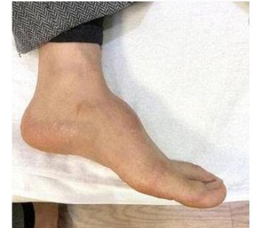 脚背长了一个包,像软骨,按压时不痛,请问这是什么原因造成的??