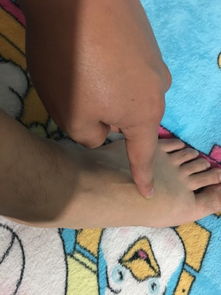 脚背长个凸起软包，脚背长个凸起软包不痛不痒
