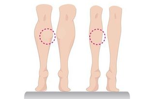 瘦腿针真的能瘦腿吗 瘦腿针有没有副作用