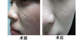 如何快速去疤痕