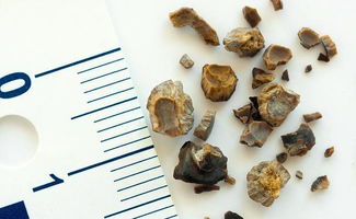 肾结石吃什么好