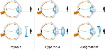 近视眼镜是凹面镜还是凸面镜