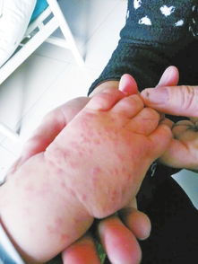 疙瘩的意思和读音