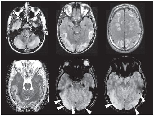 磁共振报告多久出来，脑部磁共振报告多久出来