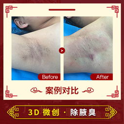 女孩子有腋臭怎么办