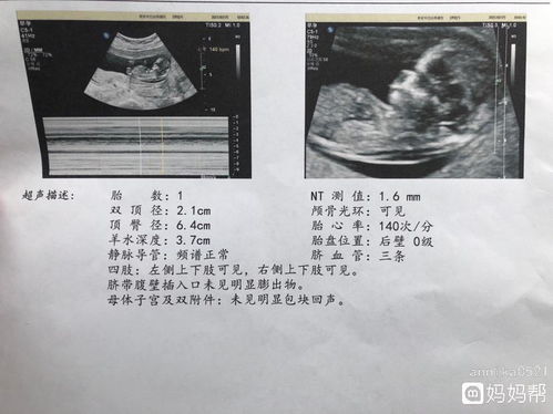 孕检nt多少是正常
