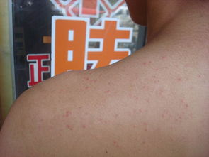 糠秕孢子菌毛囊炎，糠秕孢子菌毛囊炎怎么根治