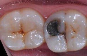 大牙齿拔掉了一定要种牙吗，大牙换不换