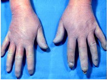 发绀是什么意思，发绀的症状