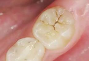 大牙的英文字怎么说