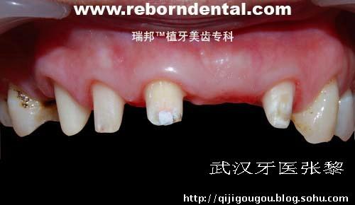 牙齿外突矫正多少钱，牙齿外突是什么原因引起的