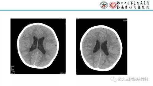 灰质的读音灰质的读音是什么