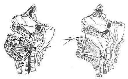 由于舌后坠导致的窒息,应当用以下哪种线将舌牵出