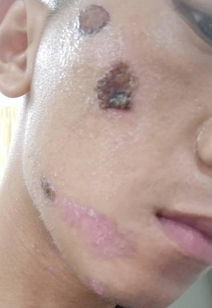 痂怎么读什么意思