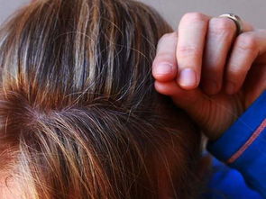 拔头发是什么病