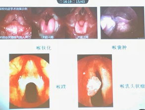 喘鸣[chuǎn míng]什么意思?近义词和反义词是什么?英文翻译是什么