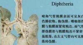 diphtheria疫苗，diphtheria怎么读