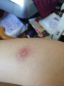 结疤留下了印子怎么办，结疤了抠掉会怎么样