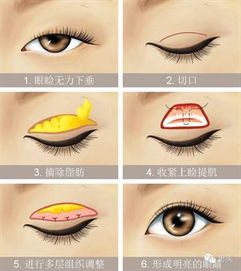 眼睑松弛综合征，眼睑松弛怎么办