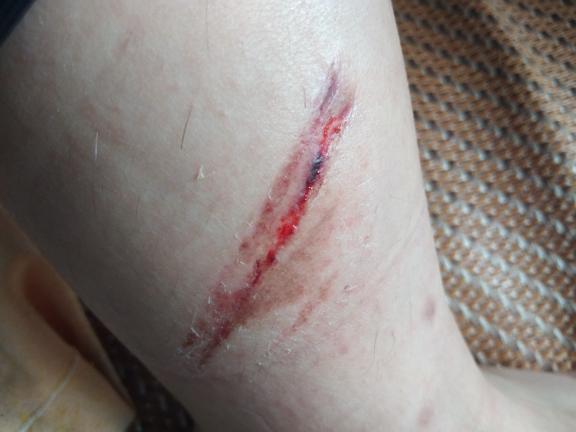 结疤[jié bā]什么意思?近义词和反义词是什么?英文翻译是什么?_百度