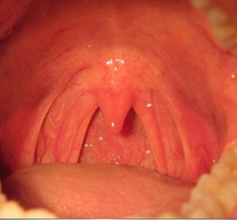 咽喉有异物感或阻塞感怎么回事，咽喉炎挂什么科