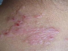 脸上长癣的图片和症状