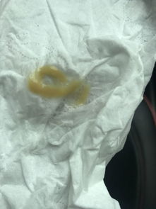 口痰多是什么原因，口痰里面有血丝是什么原因