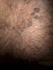 肉刺长什么样子图片 详解肉刺的外观特征及生长环境?